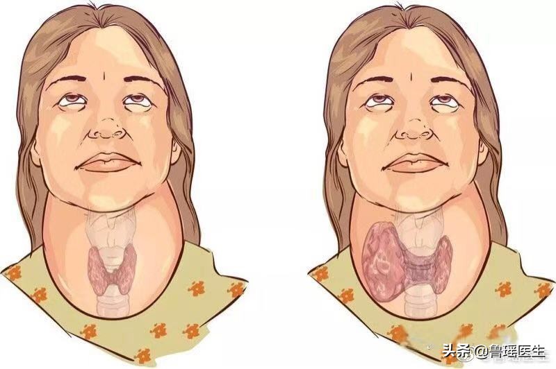 甲亢七年可以做消融吗,甲亢七年