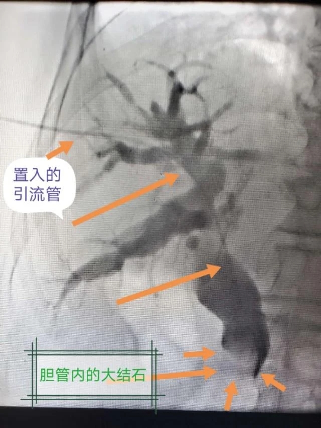 老年人夜间突发寒战高热呕吐,老人突发高热