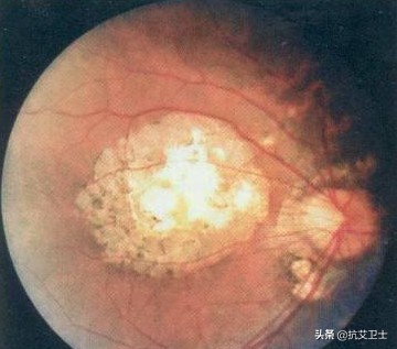 感染HIV后，这里感觉不如从前了