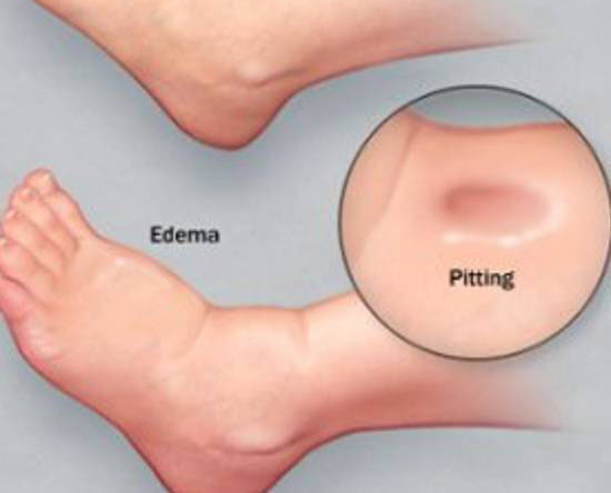 肾炎水肿常用良方西药,肾炎水肿的中药治疗方法