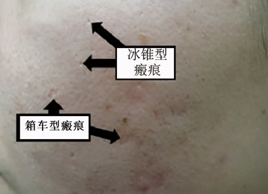 *疮痤**疤痕如何去除*疮痤**疤痕修复方法