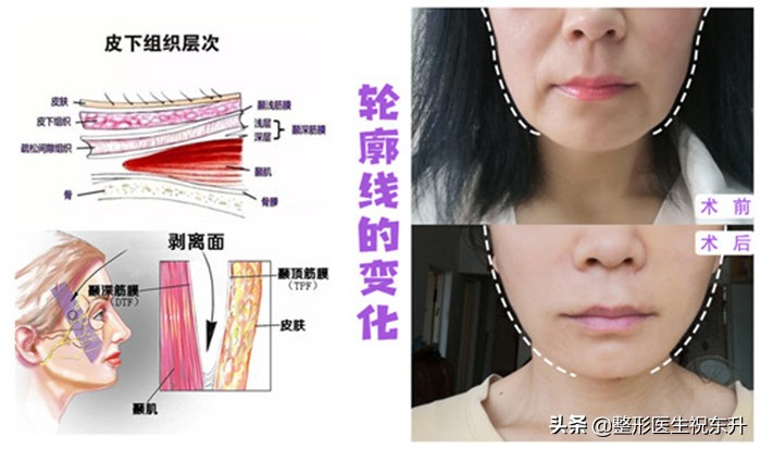 去法令纹最有效的办法亲测,去除法令纹最佳方法费用