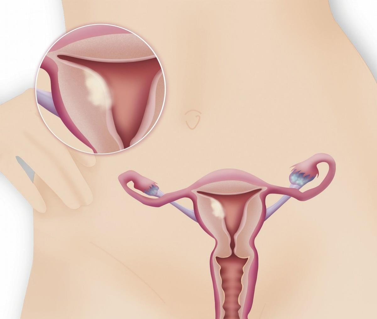 宫颈粘连有哪些症状和表现,宫颈粘连会痛经吗