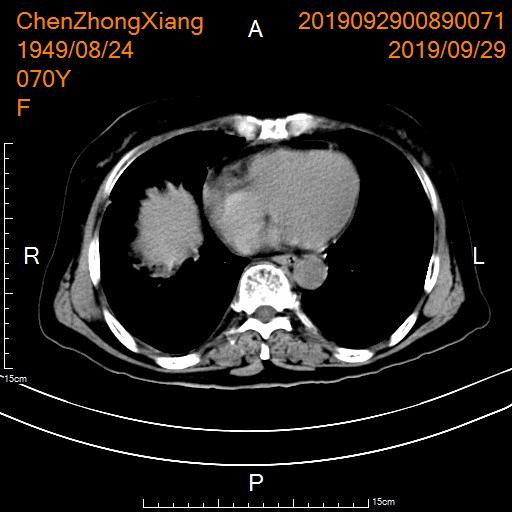 胃癌晚期化疗一次多少钱,胃癌晚期不化疗用靶向药