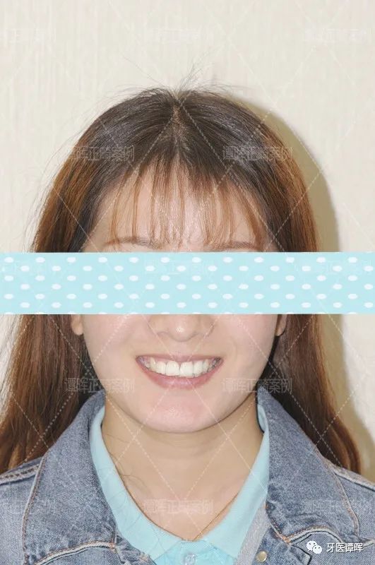 门牙前突牙齿不齐矫正案例分享,门牙和旁边牙齿不齐最快矫正方法