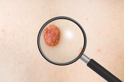 长了脂肪瘤如何防治,脂肪瘤怎样预防及治疗