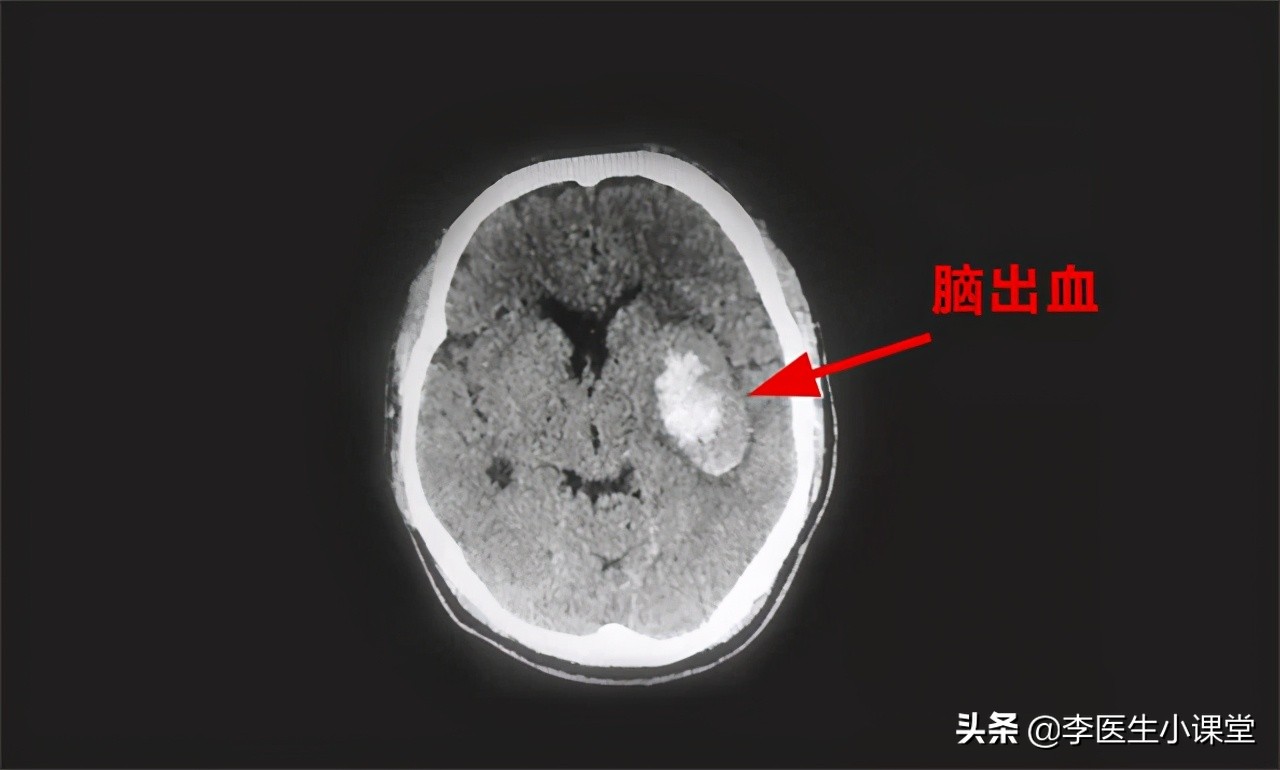 脑出血急救措施关键时刻能救命,脑出血的急救处理方法及步骤