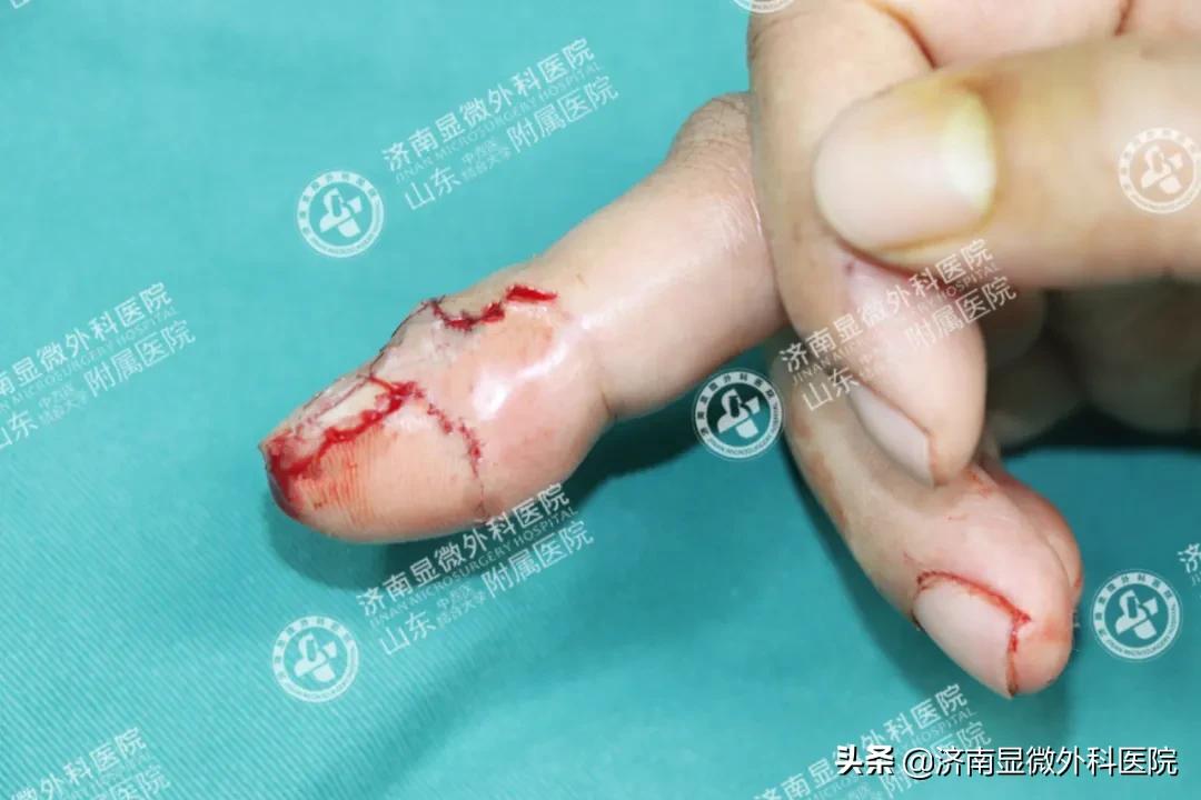 显微镜下男性复通术需要多少钱,显微镜下的手指再植