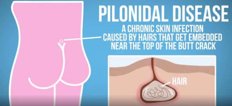 为什么屁股上会长纹,为什么屁股上会长皮癣