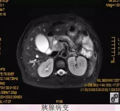 核磁共振能看出来哪些病症,核磁共振可以检查良恶性吗