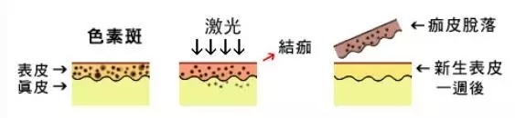 雀斑黄褐斑晒斑如何去除,晒斑雀斑淡斑最简单有效的方法