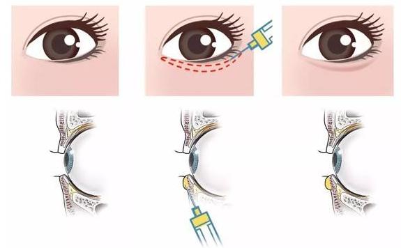 眼袋和卧蚕的区别教你区分小妙招,卧蚕和眼袋傻傻分不清的说说