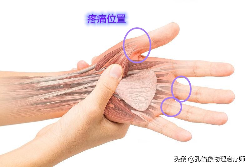 中年人患腱鞘炎怎么治,中老年腱鞘炎特效药