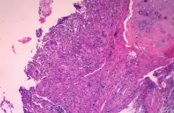 肺炎治疗7天症状好转ct无好转,肺炎治快二个月还没好