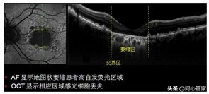 斑块和血栓ct区别,斑块和血栓的超声鉴别