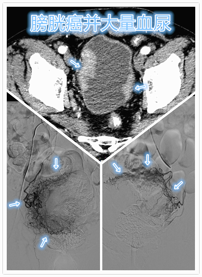 膀胱癌出现大量血尿怎么办吧?
