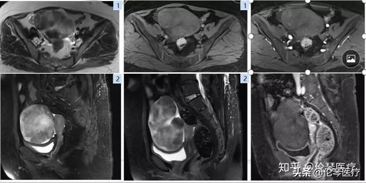 卵巢肿瘤核磁共振能看出来吗,超声测出来肿瘤