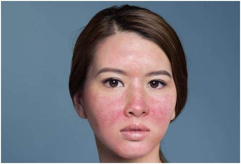 实用帖:玫瑰*疮痤**不可怕,可怕的是你不够重视它