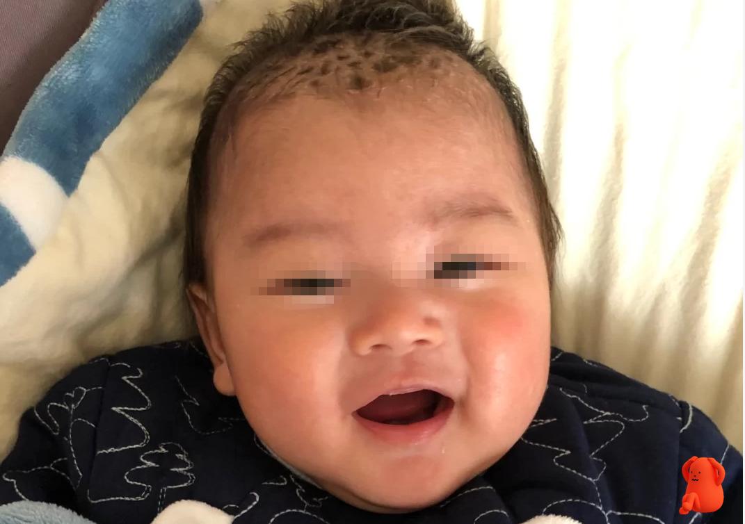 宝宝乳痂怎么去除,手贱扣痂会留印吗