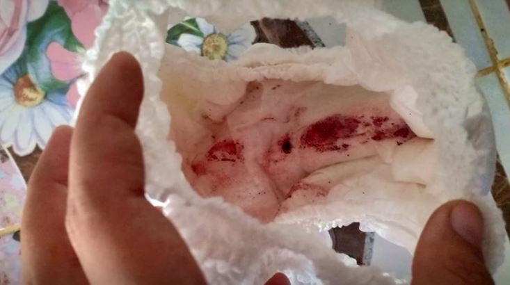 水蛭钻入身体两年了怎么办,水蛭真的会钻入人体吗