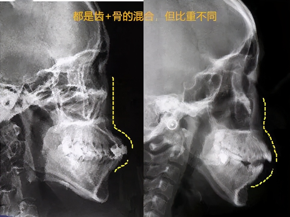 突嘴正颌手术有哪些风险,正颌手术凸嘴3d动画演示