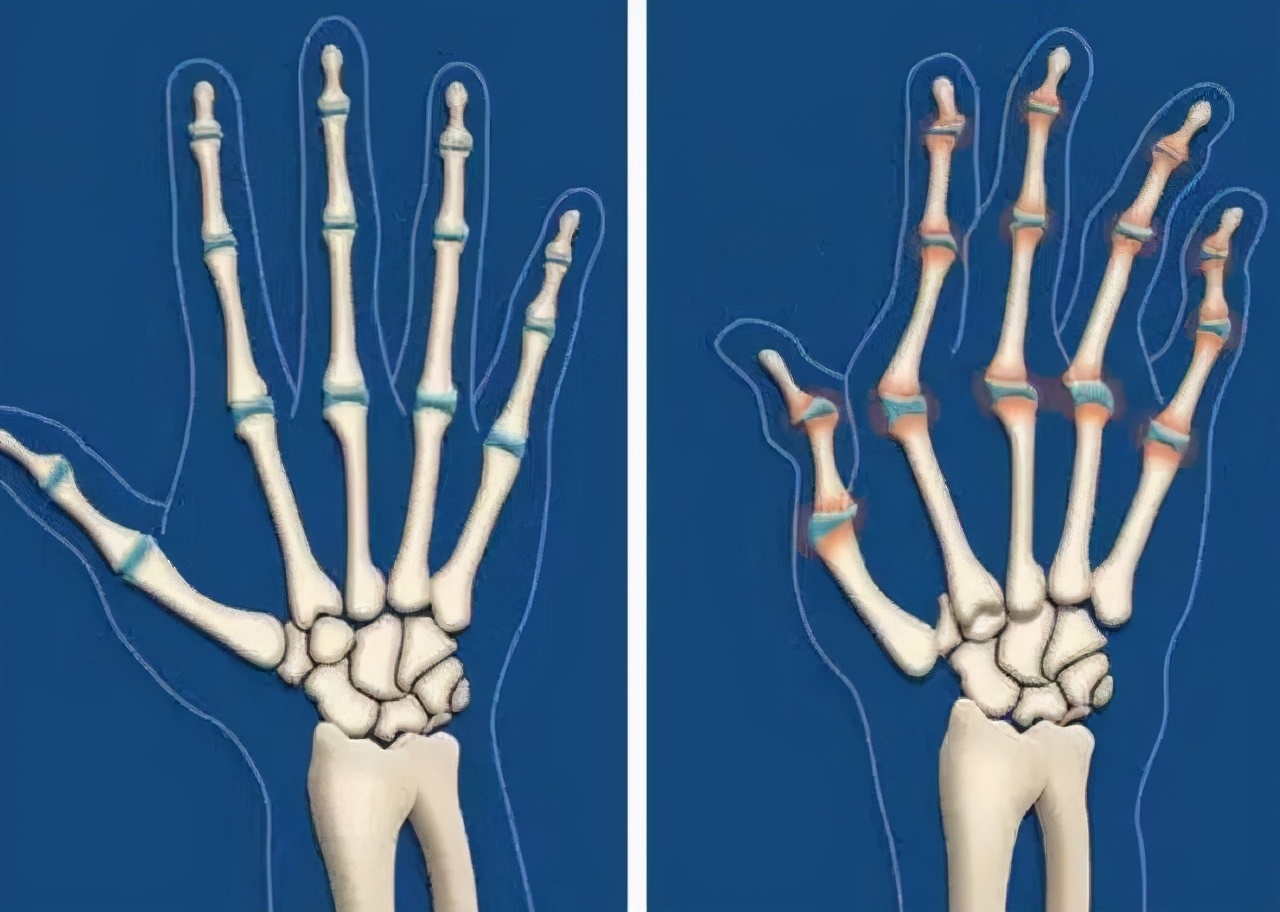 风湿关节痛和痛风是一样的吗,大关节痛是痛风还是类风湿