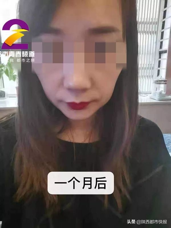 可怕！两女子6年交情“一针”终结！西安女孩瘦脸不成“脸塌了”