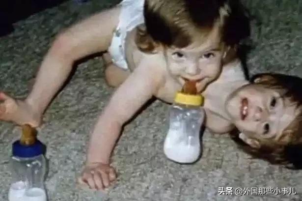 罕见双头连体人能活多久,诡异的双头生物