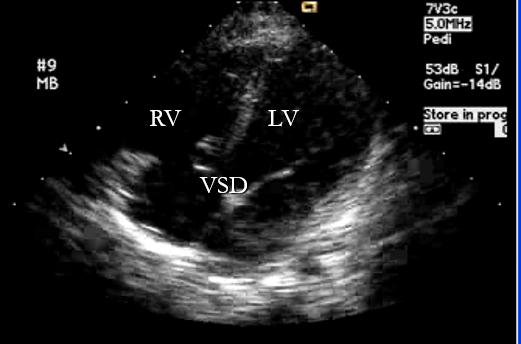 小孩子心脏没有闭合多大要做手术,小孩心脏没长拢做手术费用高吗