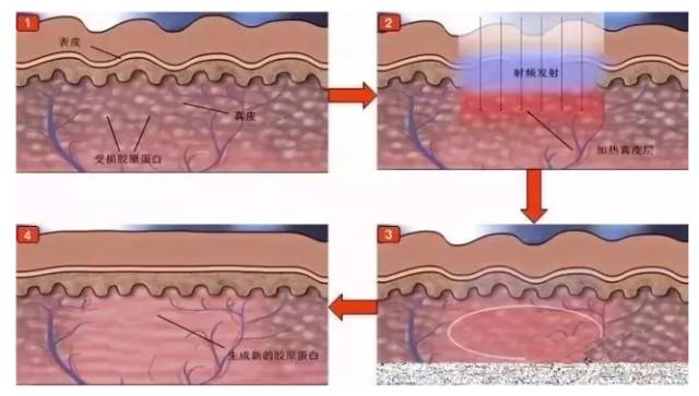光子嫩肤的注意事项有哪些,光子嫩肤后需要注意的事项有哪些