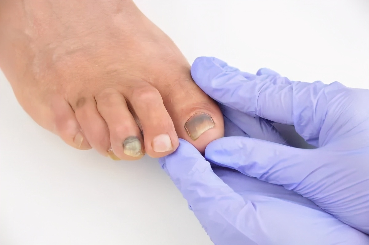 得了灰指甲涂什么药膏,女生得了灰指甲怎么办