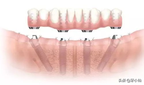 老人牙齿全坏了怎么办,老人牙掉了剩几颗怎么修复