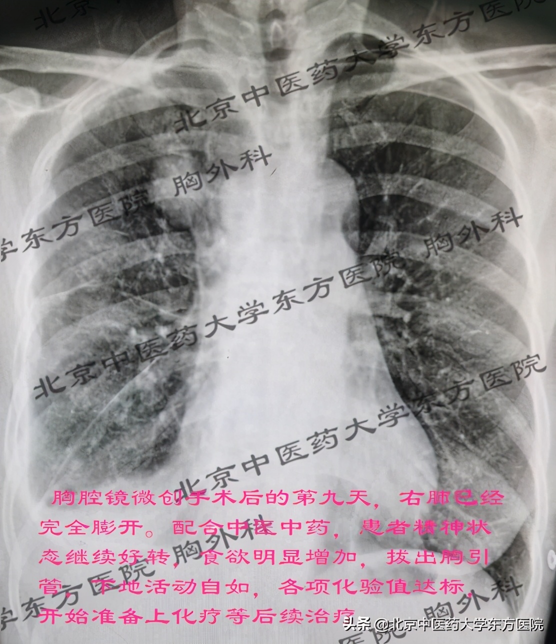 北京治疗胸腔积液哪个医院权威,中医治疗心脏胸腔积液