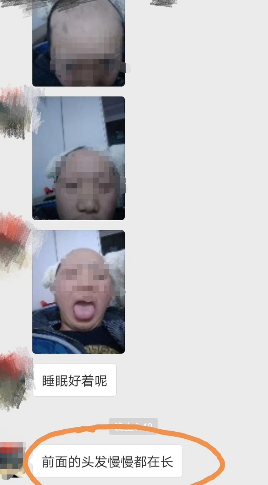 分享一些有什么解决脱发的方法吧,脱发分享