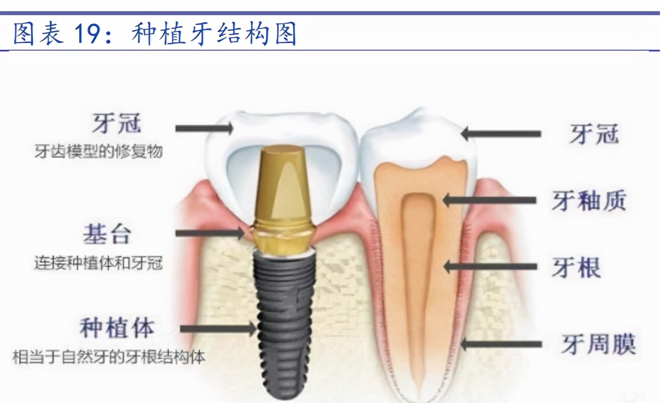 A股潜力赛道：千亿种植牙市场,附股）