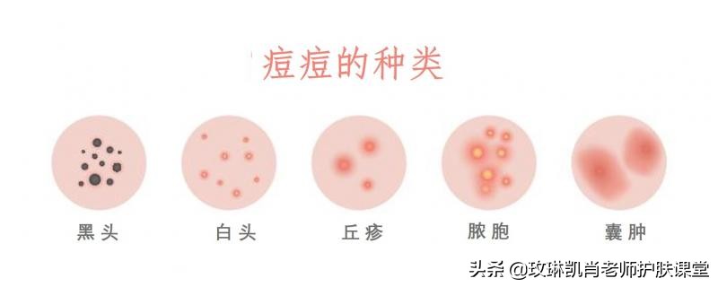 额头脸颊下巴长痘怎么调理,额头脸颊下巴反复长痘如何调理