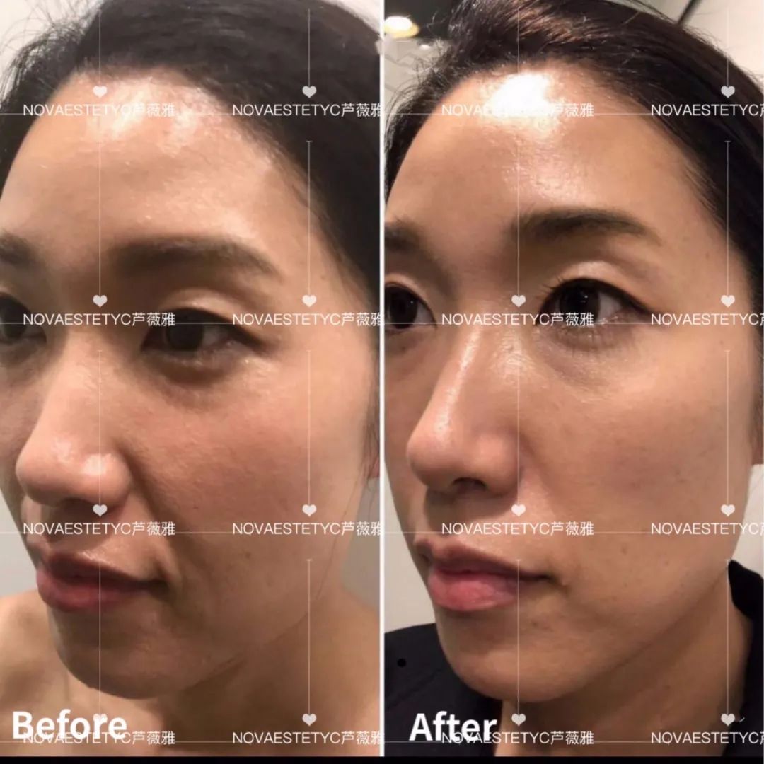 “无痛版热玛吉”问世，抗衰市场迎来最强玩家？