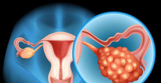 子宫切除跟剖腹产哪个伤害更大,子宫切除和宫颈切除哪个危害大