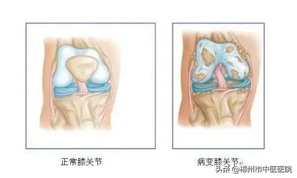 专家支招骨关节炎治疗,膝关节骨性关节炎疼痛怎么治疗