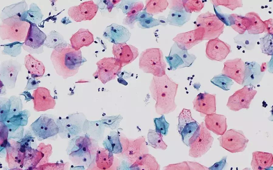 别只盯着HPV疫苗！年过25岁，却还不了解宫颈癌筛查？