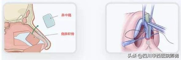鼻中隔隆鼻的优缺点,鼻中隔软骨隆鼻怎么修复