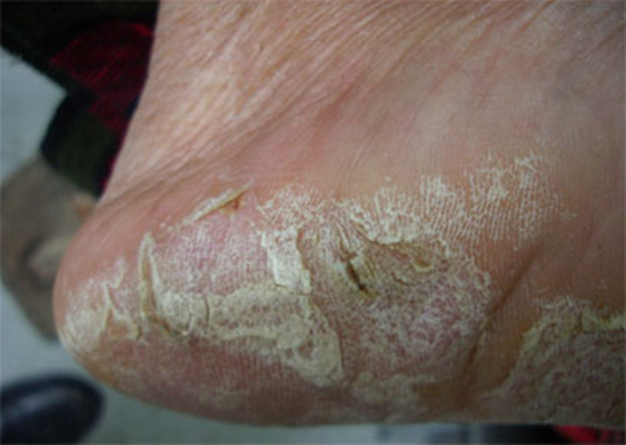 脚气好不了查什么,脚气很重谁知道怎么治疗