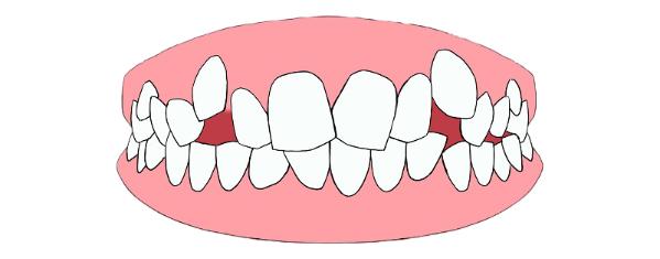 带你了解超详细的牙齿矫正过程,牙齿矫正全过程看完你就知道