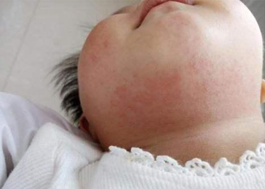 新生儿如何进行皮肤护理,新生儿皮肤常见问题照护与清洁