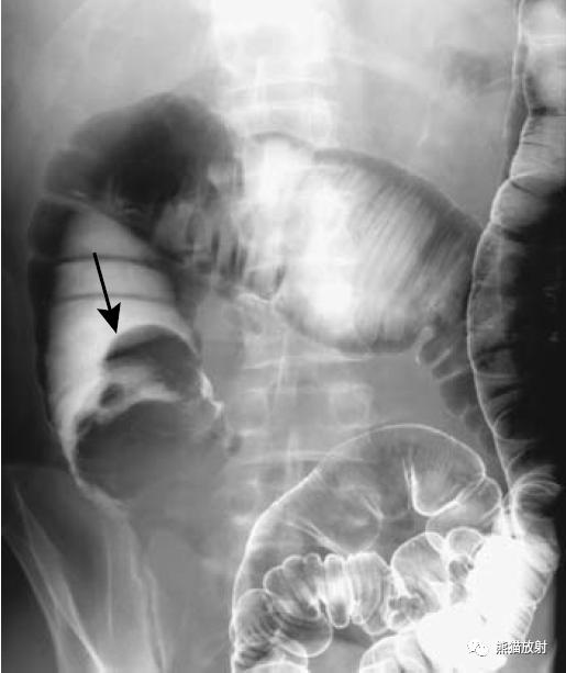 腹部影像图片大全,乙状直肠疼痛位置图片