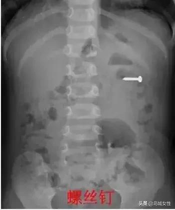 8岁男孩误吞5厘米钢钉,惊险9岁男孩误吞3厘米图钉