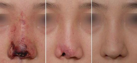 面部微整形的危害,为什么微整形面部变残