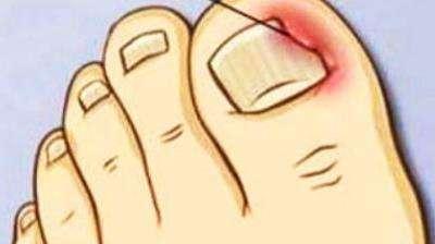 什么原因导致脚趾甲老是嵌甲,脚趾甲老是长到肉里怎么治疗啊