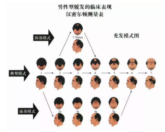 爷爷秃顶孙子一定秃顶吗,爷爷秃头爸爸是秃的儿子会秃吗