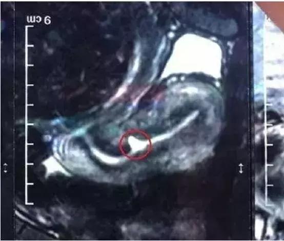子宫憩室手术后怎么调理身体,子宫憩室手术后还会有憩室吗